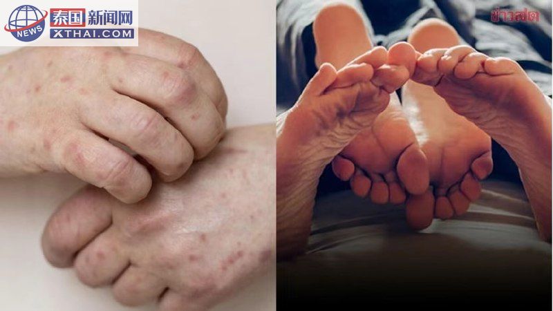 泰国性传播疾病感染率猛增80%！清迈成重灾区，梅毒淋病成为”隐形炸弹”！2025年数据曝光，专家发出紧急警告！